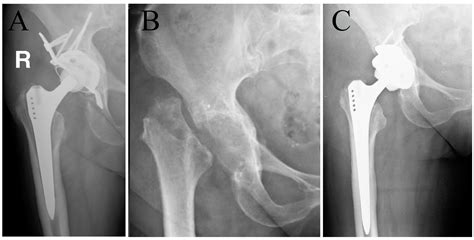 infected hip arthroplasty icd 10.